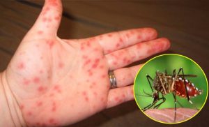 Bệnh Sốt Xuất Huyết - Trường Mầm Non STEAM KIDS