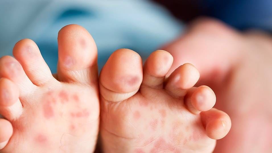 5 Bệnh Nguy Hiểm Thường Gặp Ở Trẻ Mùa Hè 5 Bệnh Nguy Hiểm Thường Gặp Ở Trẻ Mùa Hè - Trường Mầm Non STEAM KIDS