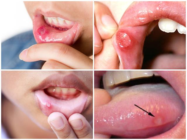 Những Mẹo Vặt Hữu Hiệu Khi Trẻ Bị Nhiệt Miệng Những Mẹo Vặt Hữu Hiệu Khi Trẻ Bị Nhiệt Miệng - Trường Mầm Non STEAM KIDS